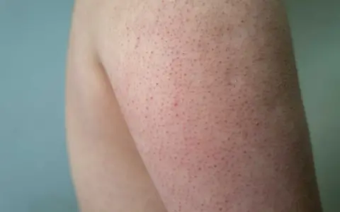 När huden på armarna blir kall kan den likna kycklinghud med små röda prickar.