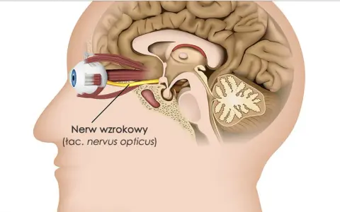 Przekrój głowy ukazujący oko i nerw wzrokowy. Obrzęk tarczy nerwu wzrokowego objawy mogą być widoczne w tej okolicy.
