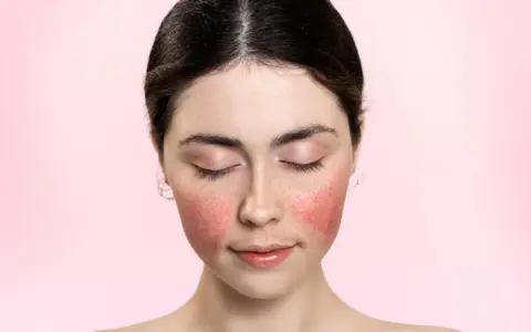 Rötungen im Gesicht, vielleicht eine retinol warnung? Die Haut ist gerötet, die Augen geschlossen.
