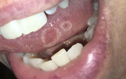 Lingua con afte dolorose. Le lesioni biancastre e rosse sono visibili sulla superficie della lingua, circondate da un alone infiammato.