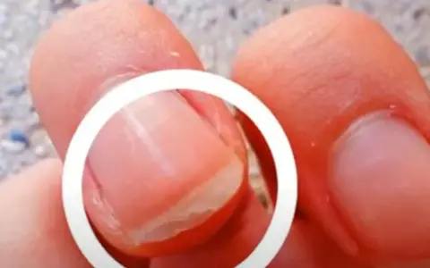 Gros plan sur un ongle qui se dédouble, montrant les couches séparées. Comprendre pourquoi les ongles se dédoublent peut aider à prévenir ce problème.