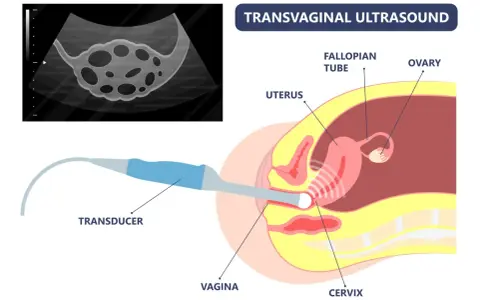 Transvaginaler Ultraschall zur Diagnose von Endometriose. Ein Ultraschallkopf wird in die Vagina eingeführt, um Gebärmutter, Eierstöcke und Eileiter abzubilden.