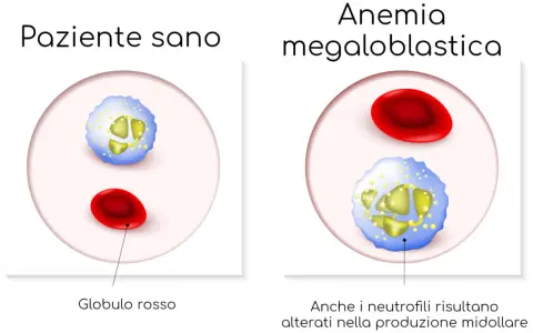 Confronto tra globuli rossi e neutrofili di un paziente sano e uno con anemia megaloblastica, dove i neutrofili appaiono alterati.