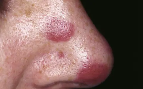 Lesioni cutanee violacee sul naso, indicative di sarcoma di Kaposi.
