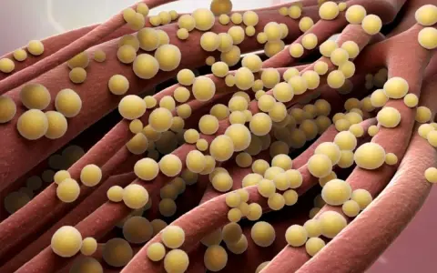 Ingrandimento di fibre rosse con batteri sferici gialli, possibile infezione naso stafilococco.