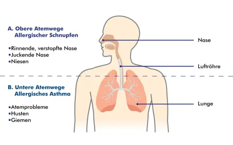 Schema zeigt obere Atemwege (allergischer Schnupfen) und untere Atemwege (allergisches Asthma). So kann man allergisches Asthma behandeln.