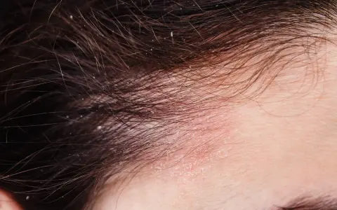 Nahaufnahme der Kopfhaut mit roten, schuppigen Stellen und feinen Haaren. Dies deutet auf Schuppenflechte am Kopfhautrand hin, die auch Haarausfall verursachen kann.