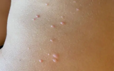 Piccolo dettaglio della pelle di un bambino con molluschi contagiosi, piccole protuberanze rosee che sembrano minuscoli molluschi.
