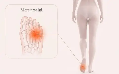 Illustration av en fot med markerad smärta i framfoten, som visar metatarsalgi. En figur visar smärtan i foten.
