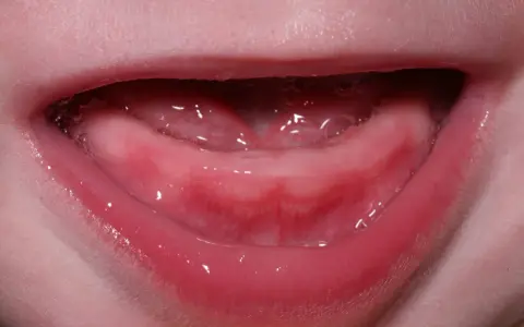 Gengive rosse e gonfie di un neonato, con piccole bollicine di saliva. Inizia la dentizione, un momento emozionante per la dentizione del neonato.