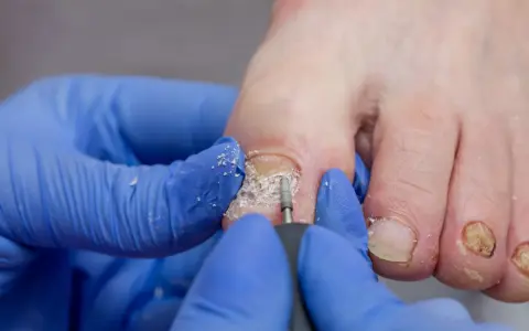 Podolog z niebieskimi rękawiczkami używa frezarki do paznokci, aby oczyścić zniszczony paznokieć u stopy. To wizyta u lekarza do jakiego lekarza z paznokciami.