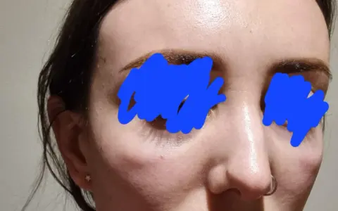 Widoczna opuchlizna po laserze frakcyjnym pod oczami i na policzkach. Skóra jest lekko zaczerwieniona i błyszcząca.