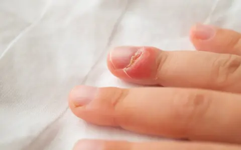 Gros plan sur un doigt d'enfant présentant une rougeur et une inflammation autour de l'ongle, suggérant une mycose ongle bébé.