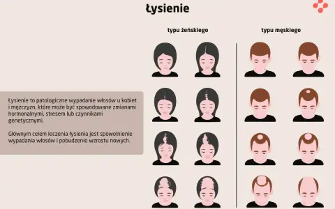 Ilustracja pokazuje różne etapy łysienia androgenowego u kobiet i mężczyzn. Widać stopniową utratę włosów, od przerzedzenia po całkowite wyłysienie.