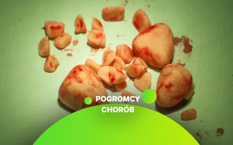 Kamień w przewodzie moczowym jak wysikać? Zobacz usunięte kamienie nerkowe, które mogą powodować ból i problemy z oddawaniem moczu.