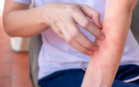 Dito, una persona si gratta il braccio, mostrando piccole macchie rosse che suggeriscono una sensazione di bruciore sulla pelle senza arrossamento visibile.