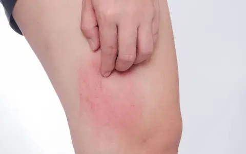 Rote, juckende Stelle am Bein, ein mögliches Symptom von Diabetes haut.