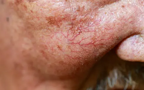 Couperose-Kosmetik: So beruhigen Sie rote Äderchen wirklich