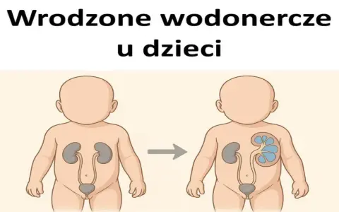 Ilustracja pokazuje powiększoną nerkę u dziecka, co może być objawem wrodzonych wad układu moczowego.