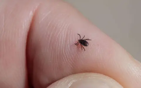Kleszcz nie wchodzi pod skórę! Jak usunąć i co obserwować?