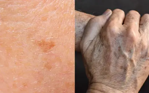 Nahaufnahme von Haut mit Pigmentflecken, Falten und Altersflecken. Retinol gegen Pigmentflecken kann helfen, das Hautbild zu verbessern.