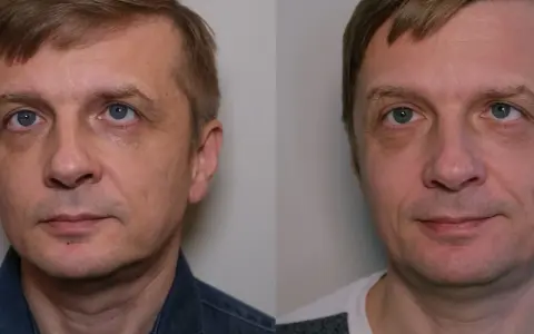 Laser frakcyjny nieablacyjny: Czy warto? Efekty, cena, opinie