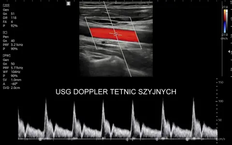 USG doppler tętnic szyjnych pokazuje przepływ krwi. Analiza wykresu dopplerowskiego może pomóc w ocenie objawów chorób naczyniowych.