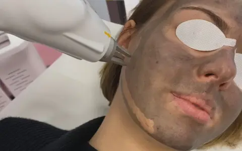 Zabieg laserowy na twarz z maską węglową. Skóra przygotowana do peelingu węglowego.