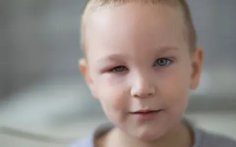 Mały chłopiec z niebieskimi oczami, u którego widoczne jest spuchnięte oko.
