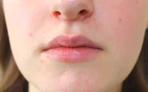 Primo piano del viso con labbra e naso. Si nota una leggera dermatite intorno al naso, con arrossamenti e piccole imperfezioni.