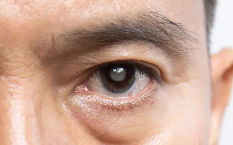 Occhio con opacità del cristallino (pseudofachia) e segni di possibile distacco retina.
