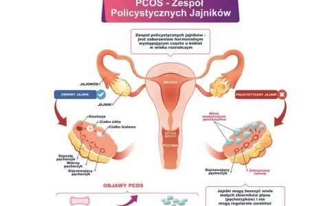 Ilustracja przedstawia budowę jajników, porównując zdrowy jajnik z jajnikiem w zespole policystycznych jajników (PCOS). W tym drugim widoczne są liczne niedojrzałe pęcherzyki.