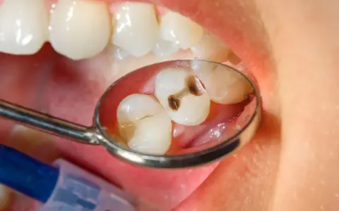 Zęby z próchnicą widziane w lusterku dentystycznym. Ksylitol, naturalny słodzik, może pomóc w zapobieganiu próchnicy.