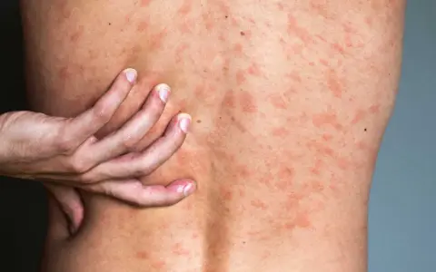 Une main gratte le dos couvert de plaques rouges, signe d'urticaire due au stress.