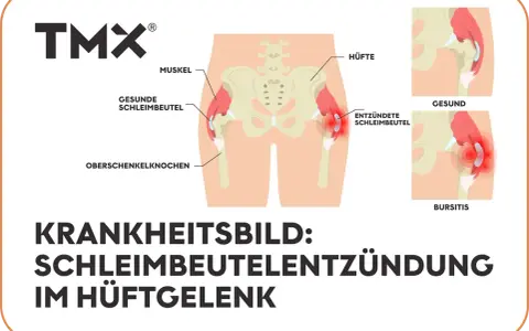 Illustration zeigt das Hüftgelenk mit gesunden und entzündeten Schleimbeuteln. Bursitis trochanterica als Krankheitsbild.
