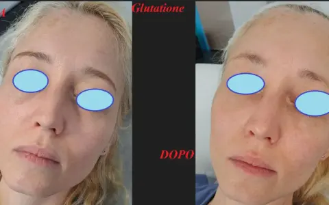 Prima e dopo un trattamento di glutatione per un miglioramento visibile del risultato peeling chimico.