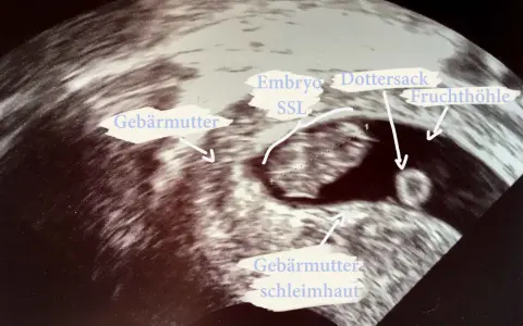 Ultraschallbild zeigt frühe Schwangerschaft: Gebärmutter, Fruchtblase, Dottersack und Embryo (SSL).