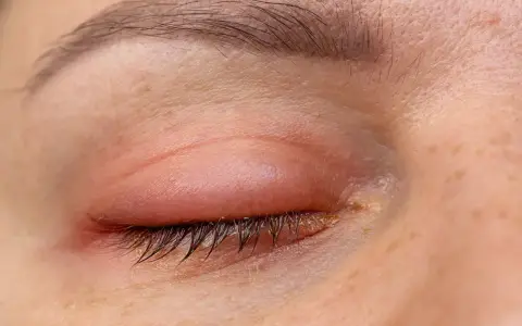 Ojo hinchado al despertar, con enrojecimiento e irritación en el párpado.