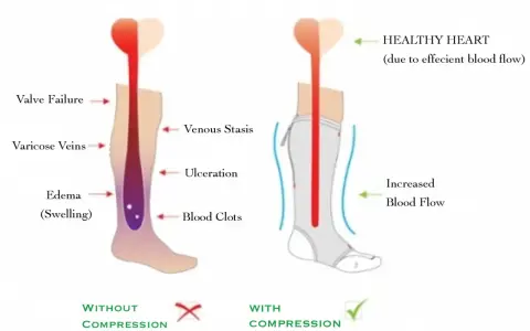 Diagram shows how compression stockings help with inflammation by improving blood flow, preventing issues like edema and varicose veins.