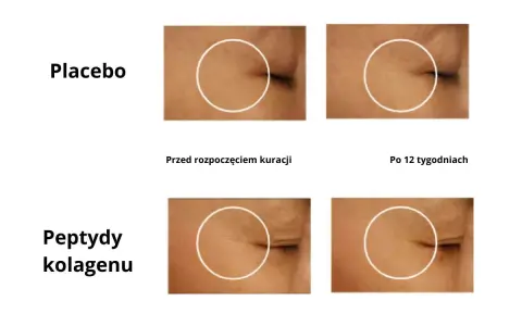 Porównanie skóry przed i po 12 tygodniach: placebo vs. peptydy kolagenu.