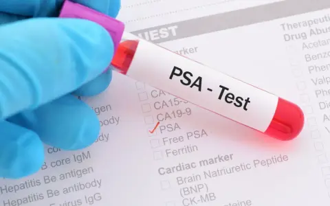 Rękawiczka w niebieskiej rękawiczce trzyma probówkę z krwią do testu PSA. Na formularzu zaznaczono PSA.