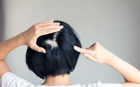 Eine Frau entdeckt kreisrunden Haarausfall am Hinterkopf. Ihre Hände berühren die kahle Stelle, die sich deutlich vom dunklen Haar abhebt.