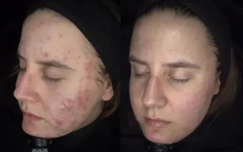 Przed i po: widoczna poprawa cery z trądzikiem, co sugeruje skuteczne metody, jak obniżyć DHT.