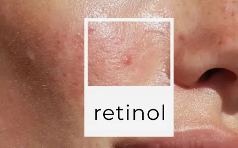 Zbliżenie na skórę z widocznymi niedoskonałościami, zaczerwienieniami i wypryskami. W ramce tekst "retinol", sugerujący wysyp po retinolu.