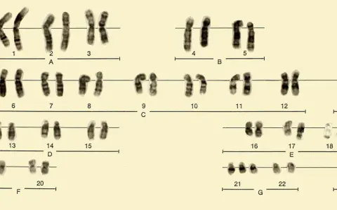 Cariotipo masculino con cromosomas ordenados por tamaño y forma, incluyendo los cromosomas sexuales X e Y.