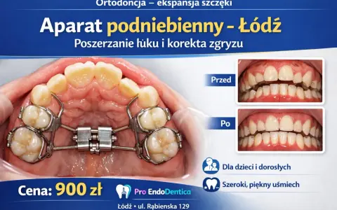 Aparat podniebienny, czyli aparat Hassa, poszerza łuk zębowy. Zdjęcia pokazują efekt przed i po leczeniu.
