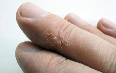 Gros plan sur des doigts montrant une peau sèche et craquelée, avec une crevasse visible sur un doigt.