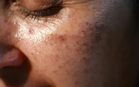 Gros plan sur la peau du visage, montrant des taches brunes. Des conseils sur comment enlever les taches brunes sur le visage pourraient être utiles.