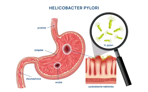 Ilustracja anatomiczna żołądka z wrzodami i bakteriami Helicobacter pylori pod lupą.