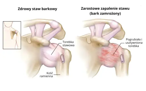 Porównanie zdrowego stawu barkowego z objawami zamrożonego barku: pogrubiała i usztywniona torebka stawowa.
